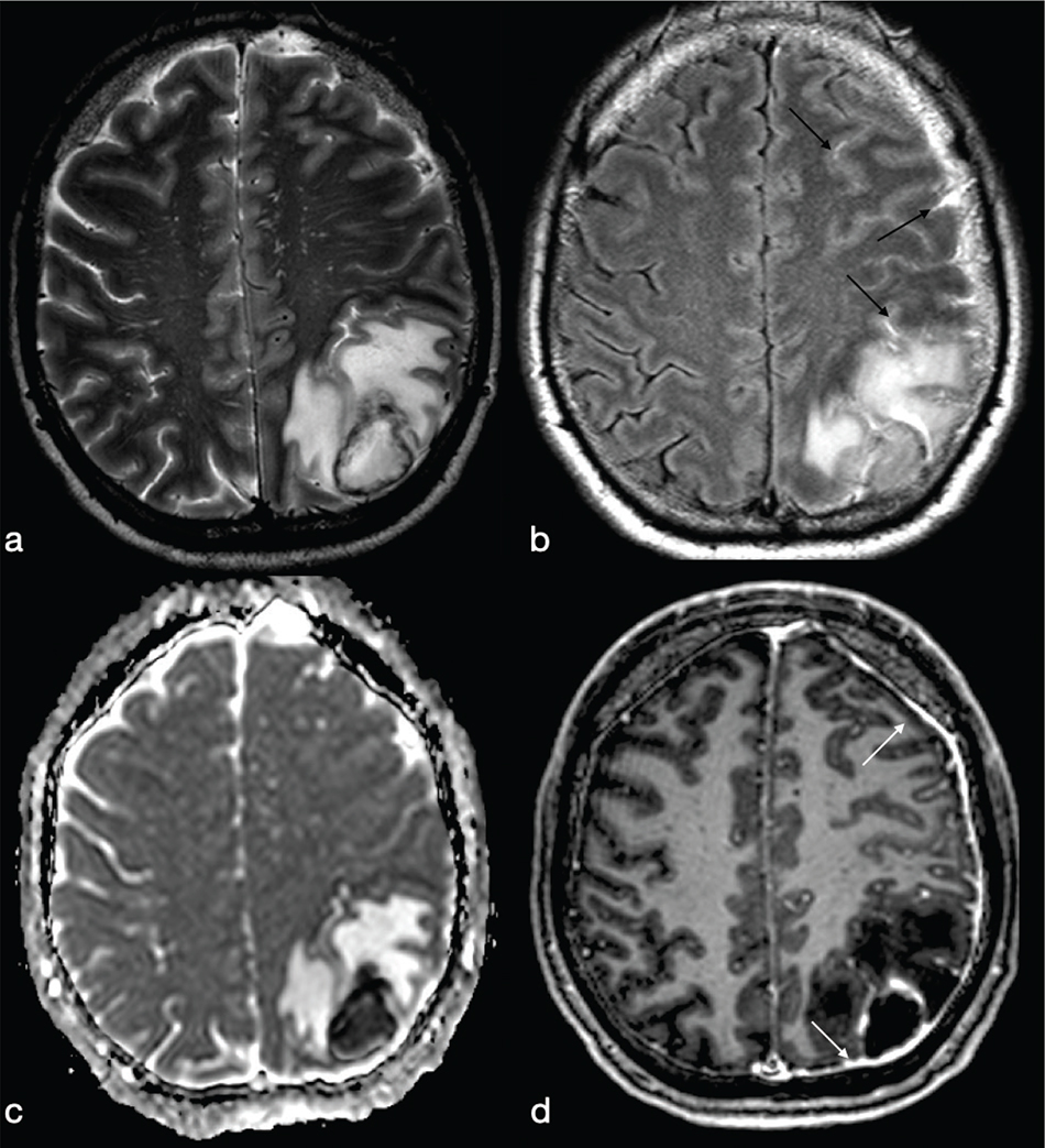 Cureus | Neurocysticercosis: An Easy to Miss Diagnosis in Non-Endemic  Regions | Article