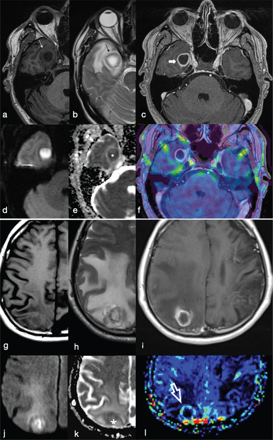 Biomedicines | Free Full-Text | Magnetic Resonance Imaging of Primary Adult Brain  Tumors: State of the Art and Future Perspectives